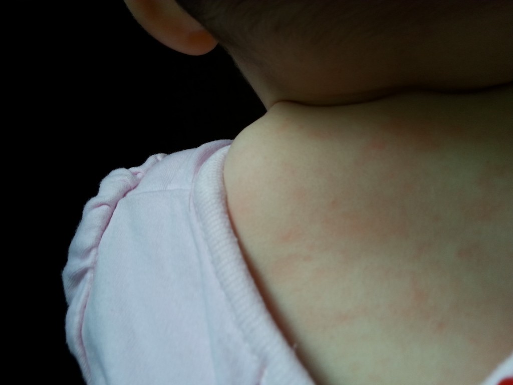 Baby rash - german measles?