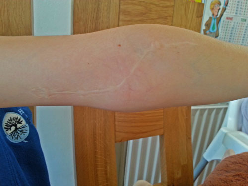Old scar on a child's arm