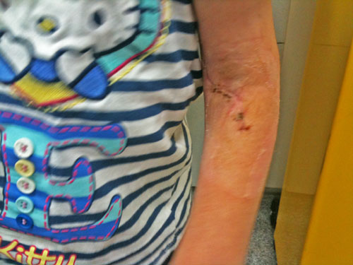 Scar on a child's arm - Feeling like a bad mum www.FranglaiseMummy.com